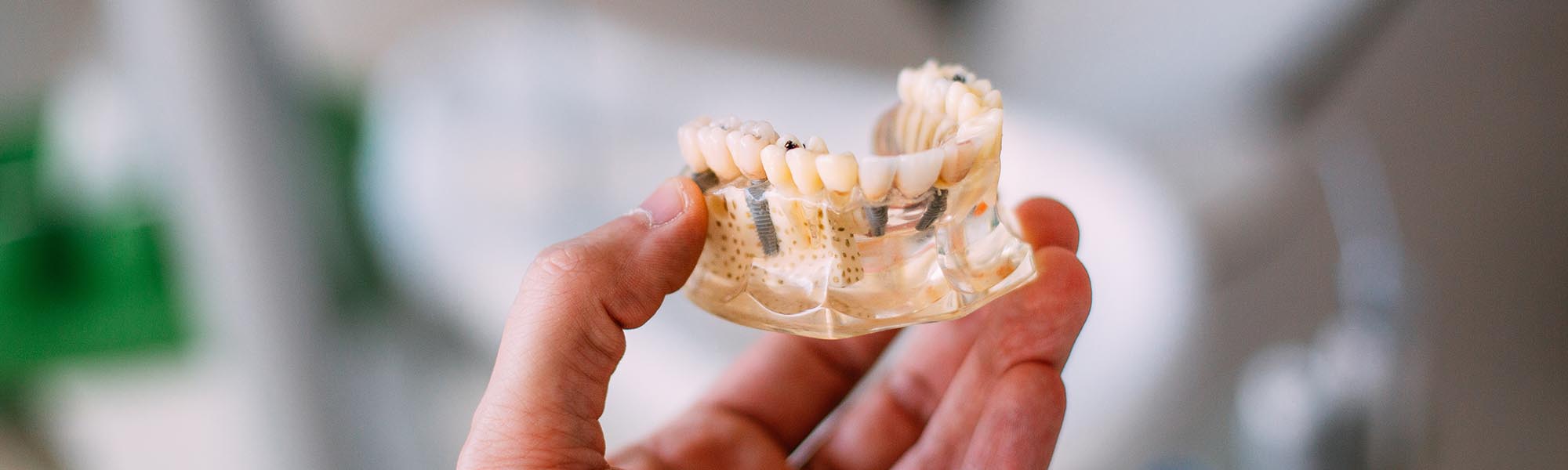 All-on-4 Dental Implants Downey CA