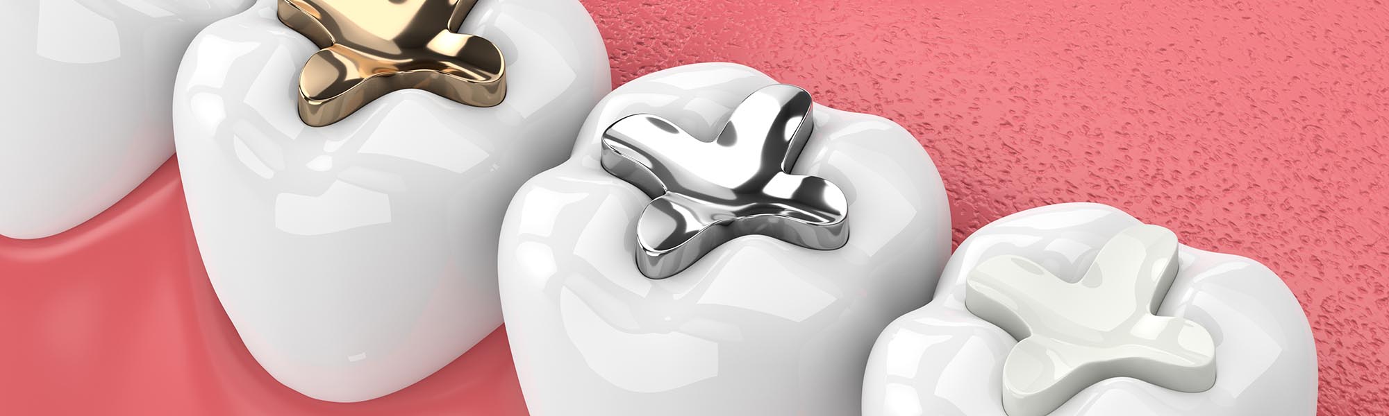 Composite Fillings Downey CA