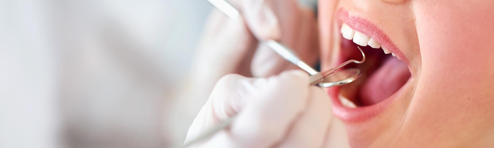 Periodontal (Gum) Disease Prevention Dentist in Downey CA